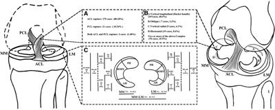 Epidemiology and distribution of cruciate ligament injuries in children and adolescents, with an analysis of risk factors for concomitant meniscal tear